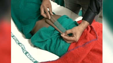 Neurosurgeons -remove -18 cm-long -'tail'- from -Nagpur- boy's- back