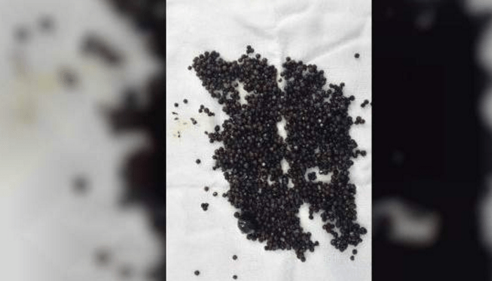 gallstones