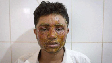 acid attack victim