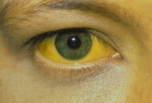 jaundice