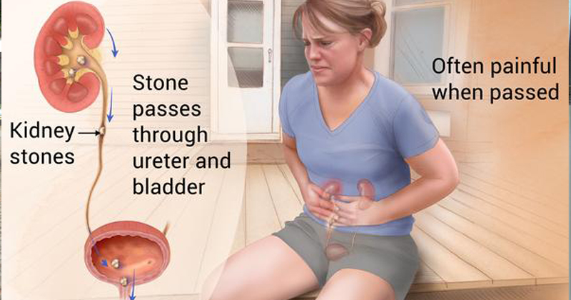 kidney stone img