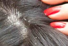 dandruff