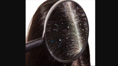 dandruff