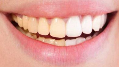 YELLOWISH TEETH