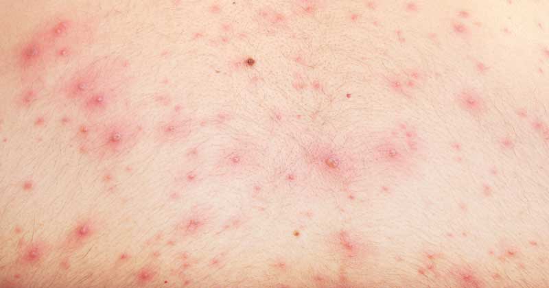 CHICKEN-POX