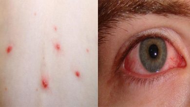 CHICKEN-POX-CONJUCTIVITIS