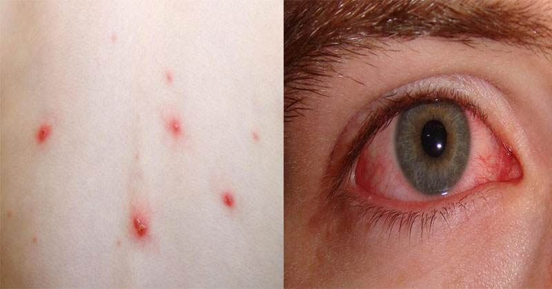 CHICKEN-POX-CONJUCTIVITIS